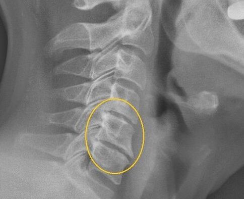 Osteohondroza kralježnice grlića maternice na x -ray
