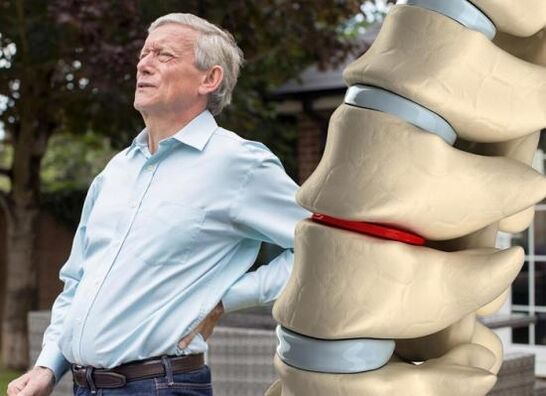 Osteokondroza utječe na intervertebralne diskove i uzrokuje bolove u leđima