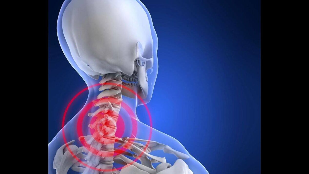 Osteokondroza vratne kralježnice